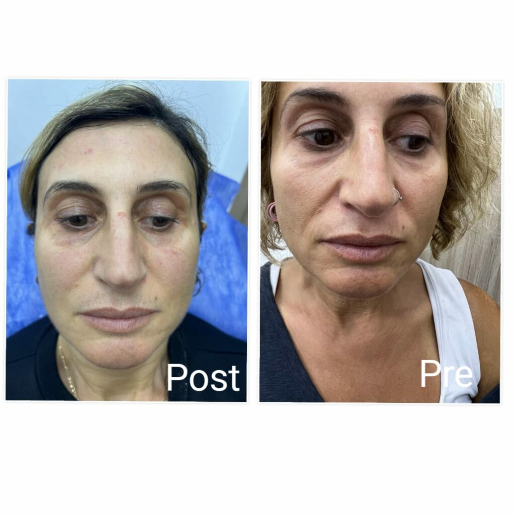 RRS injections for the skin